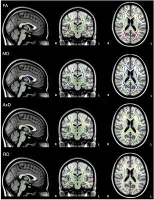 Relationship Between DTI Metrics and Cognitive Function in Alzheimer’s Disease